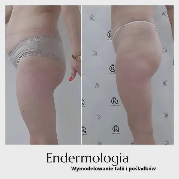 Endermologia LPG – odkryj sekret pięknej i zdrowej skóry
