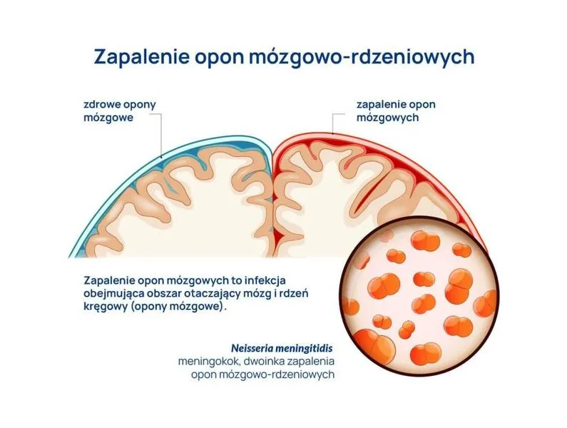 Jak rozpoznać objawy zapalenia opon mózgowych u niemowląt? Wszystko, co musisz wiedzieć